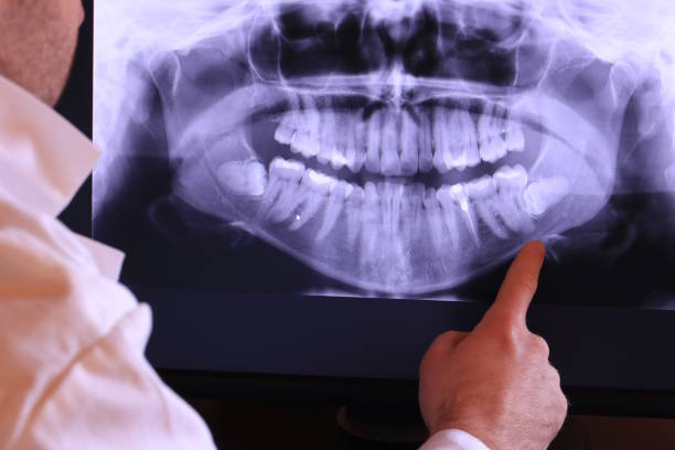 Best Emergency Treatment for Dental Infections or Abscesses in Wynantskill, NY